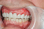 Figure 12  The provisionals immediately after treatment; the result of the soft tissue recontouring is evident.