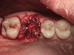 Postoperative view of bone graft, membrane, healing abutment, and sutures in place.