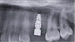 Two-month postoperative radiograph showing positive bone response.