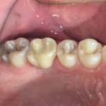 Immediate post-operative intraoral view of delivered restoration.