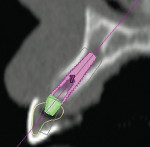 Figure 10b  Cross-sectional view(Simplant). Note placement of virtualangled abutment.