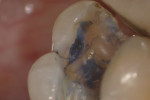 Figure 2A and Figure 2B Early-stage cracks may be asymptomatic but visible with scope and methylene blue dye (Note the mesio-buccal oblique crack line on asymptomatic upper first molar). (Figure 2A courtesy of Dr. David Clark.)