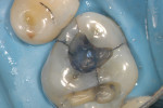 Figure 5B Enamel and dentin cracks at 8X magnification.