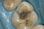 Figure 5C Note the large fracture from mesial to buccal in a vertical direction in the dentin.