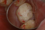 Figure 6C A core build-up provisional with articulation marks completed before definitive treatment.