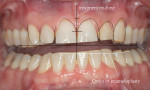 Figure 3  Significant clinical findings included a bruxing habit with moderate to heavy wear for age, gingival recession, occlusal plane cant, lack of symmetry between maxillary incisal edges and lower lip, diastemas, and alignment issues; he had oth