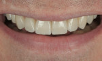 Figure 9  Close-up view of pressed minimal-preparation veneers showing that natural surface morphology can still be achieved with porcelain that is less than 0.5 mm thick.