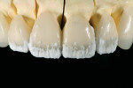 Figure 10  Minimal facial/incisal layering produced desired translucency while leaving the maximum amount of pressed lithium disilicate intact.