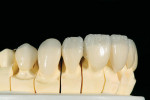 Figure 11  Minimal facial/incisal layering produced desired translucency while leaving the maximum amount of pressed lithium disilicate intact.