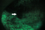 Figure 2  A repeat intraoral exam using VELscope<sup><sup>®</sup> </sup>illumination showed a loss of fluorescence, identified by the white arrow. Excisional biopsy and histologic examination gave a diagnosis of squamous papilloma. (Photos courte