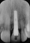 Fig 7. Immediate post-placement implant with INOL provisional.