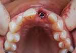 Fig 6. Implant inserted and engaging
palatal wall.