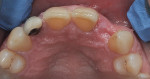 Fig 12. Healed post-extraction site, pre-placement occlusal view.