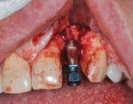 Fig 15. Placement of implant; note osseous fracture at mesial and distal of fixture.