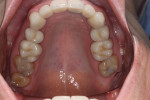Fig 7. Post-treatment, upper dentition, occlusal view.