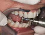 Figure 1  The use of flexible diamond-coated discs in a straight handpiece have been used in performing IPR by some clinicians even though manufacturers do not recommend their use intraorally.