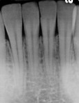 Figure 2  A radiograph showing the irreversible damage rotary discs can cause on tooth structure.