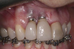 Fig 1. Implants Nos. 7 and 8 with gingival recession.