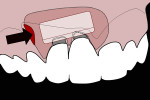 Fig 3. SCTG within lateral access pouch. Epithelial border was positioned coronally and facially.