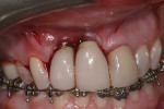 Fig 4. Lateral access, distal to implant No. 7, enabled elevation of the mucogingival pouch that extended to tooth No. 9 and placement of the SCTG.