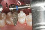 Figure 6  The final 0.5-mm blue-banded disc finalizing the interproximal reduction.