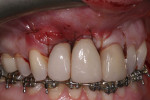 Fig 5. Mucogingival flap secured over the SCTG, implant bodies, and implant abutments.