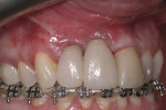 Fig 6. At approximately 6 months, sites were healthy with improved implant coverage, increased keratinized tissue width, and full interdental papillae.