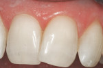 Figure 9  Simply passing a dual-coated diamond OS disc between teeth positioned like these would result in uneven reduction and anatomically mutilated contours.