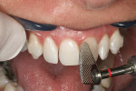 Figure 10  With water coolant, use a sweeping motion to begin removing enamel and enter the contact area from the facial aspect.