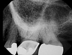 Intraoral periapical radiograph with superimposition of the zygoma.