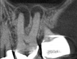 CBCT image through buccal canals revealing large periapical radiolucencies.