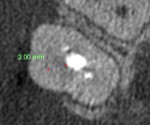 CBCT cross section showing approximate location of canal from current access preparation.