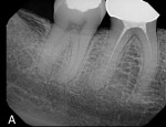 Historical preopeartive radiograph.
