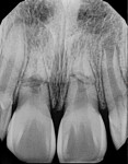 Periapical image of horizontal root fractures of tooth No. 8 and tooth No. 9.