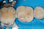 Figure 2  The defective restoration on the first lower molar was removed and prepared for an indirect onlay restoration.