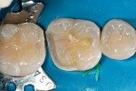 Figure 3  The tooth was prepared for an indirect onlay restoration.