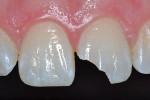 Initial image of fractured tooth No. 9.