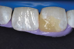 Mock-up restoration rebuilding incisal edges and mesial-incisal line angle.