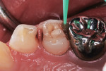 SDF applied to carious proximal tooth surfaces of 10-year-old girl.