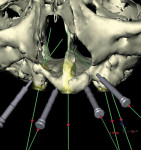 Figure 11d  CT scan (Procera) withimplants virtually placed.