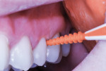 Soft dental pick delivers SDF to mesial and distal premolar surfaces.