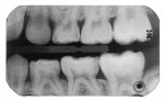 Eight-year-old with distal caries lesion seen on mandibular second molar along with mesial and distal caries lesions of maxillary first molar.