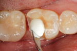 Figure 9  A temporary restoration was created using Bisco’s Pro-V Fill, a packable composite for use in onlay restorations.