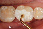 Figure 10  Pro-V Fill has excellent handling and sculpting properties offering matrix-free modeling directly in the mouth.