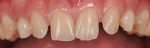 Due to the agenesis of the permanent counterparts, it is possible to note the presence
of both deciduous upper canines and many dental diastemas.
