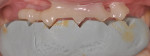 Intraoral photograph of the filled silicone guide in position, after the bis-acryl material’s setting time.