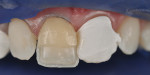 Layering of the palatal shell (Enamel White) and
dentin (Opaque A3 on the cervical, followed by Opaque A2 on the remaining buccal surface).