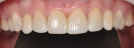 Completed restorations of all six upper anterior teeth.