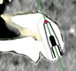 Figure 11e  Cross-sectional images, virtual treatment plan for implant placement in the anterior nasal spine region <strong>(E)</strong>, and left premolar region <strong>(F)</strong>.
