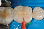 Figure 18  Excess material was immediately removed with a rubber tip and the margin was light-cured for 3 seconds to a gel state.